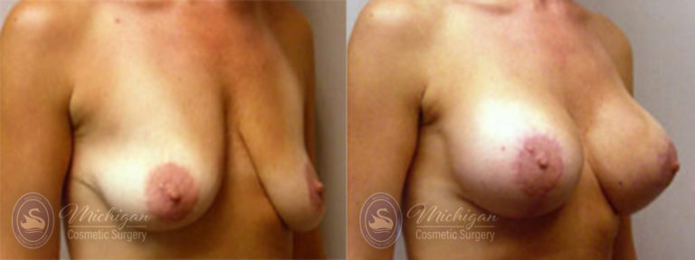 Breast Asymmetry Before and After Photo by Dr. Awada in Southfield Michigan
