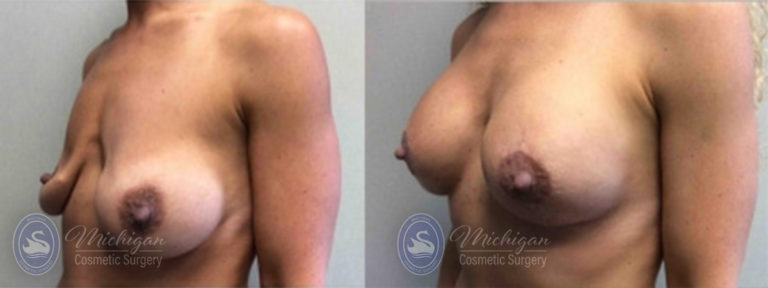 Breast Asymmetry Before and After Photo by Dr. Awada in Southfield Michigan