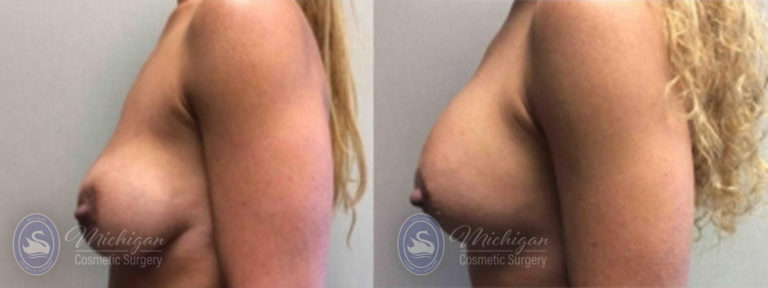 Breast Asymmetry Before and After Photo by Dr. Awada in Southfield Michigan