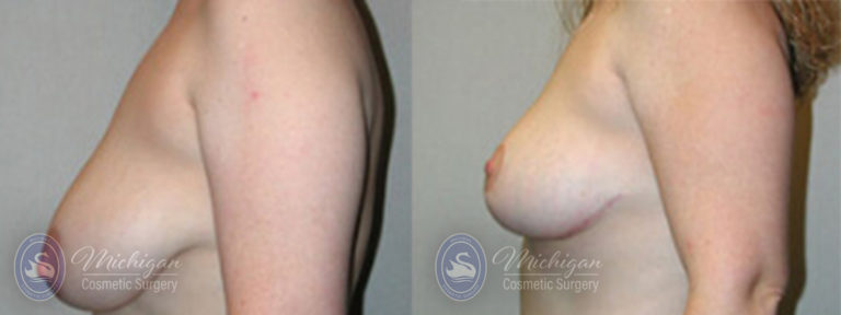 Breast Asymmetry Before and After Photo by Dr. Awada in Southfield Michigan