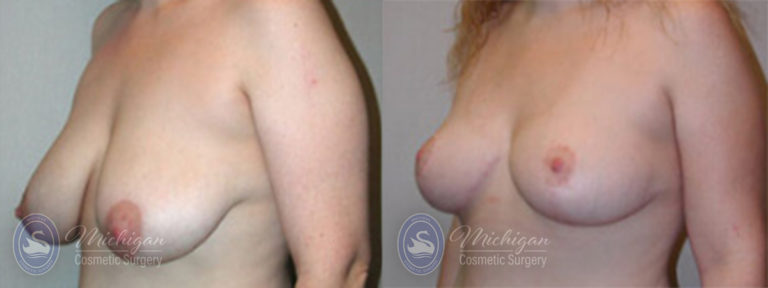 Breast Asymmetry Before and After Photo by Dr. Awada in Southfield Michigan