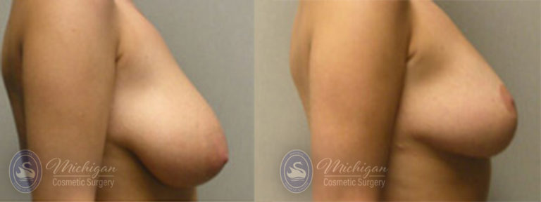 Breast Asymmetry Before and After Photo by Dr. Awada in Southfield Michigan