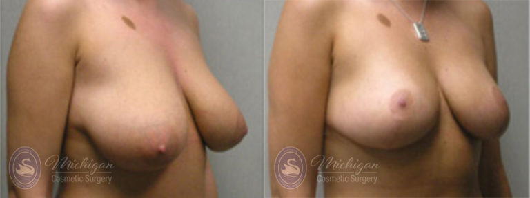 Breast Asymmetry Before and After Photo by Dr. Awada in Southfield Michigan