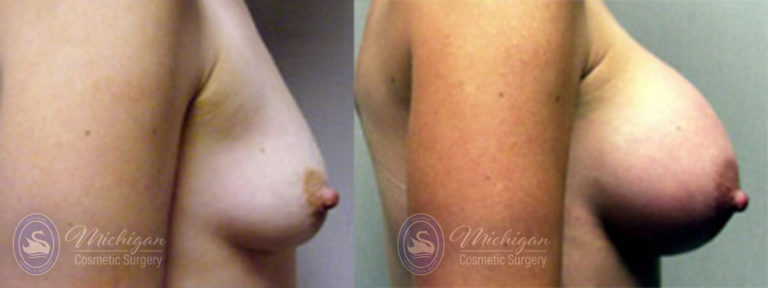Breast Asymmetry Before and After Photo by Dr. Awada in Southfield Michigan