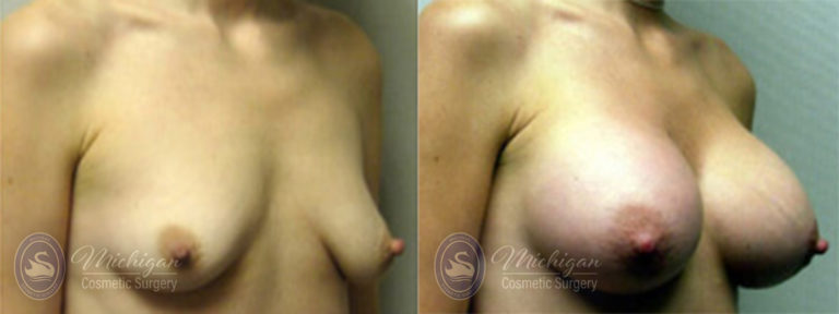 Breast Asymmetry Before and After Photo by Dr. Awada in Southfield Michigan