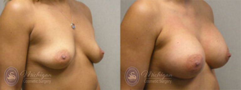 Breast Asymmetry Before and After Photo by Dr. Awada in Southfield Michigan