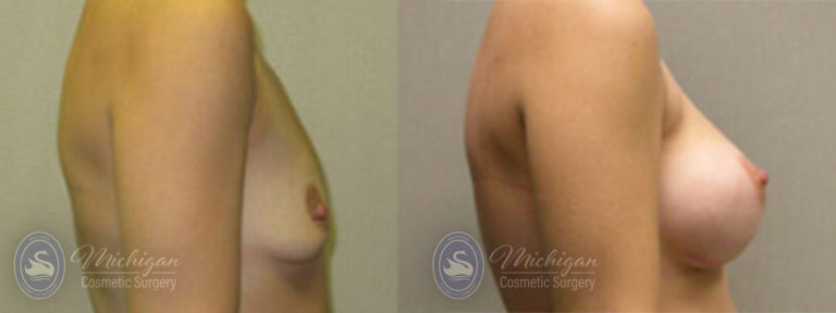 Breast Asymmetry Before and After Photo by Dr. Awada in Southfield Michigan