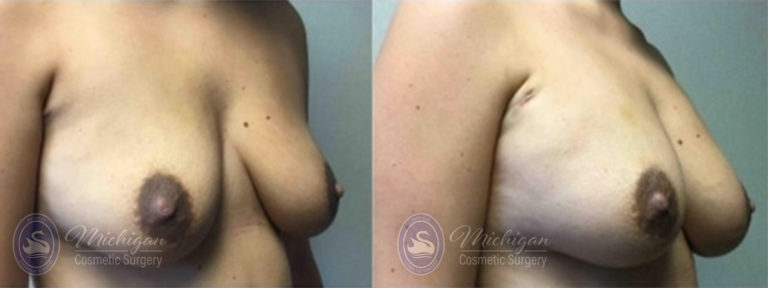 Breast Asymmetry Before and After Photo by Dr. Awada in Southfield Michigan