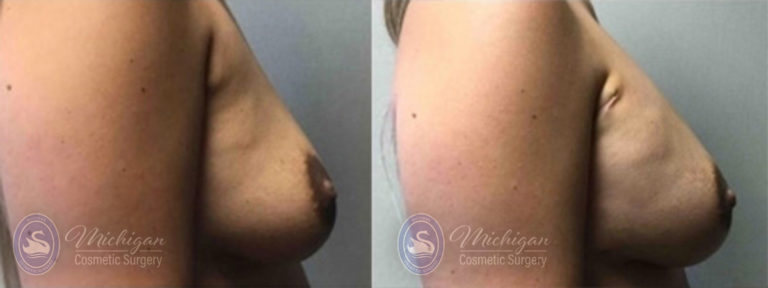 Breast Asymmetry Before and After Photo by Dr. Awada in Southfield Michigan