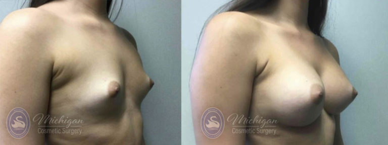 Breast Asymmetry Before and After Photo by Dr. Awada in Southfield Michigan