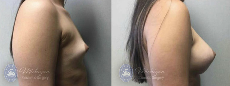 Breast Asymmetry Before and After Photo by Dr. Awada in Southfield Michigan