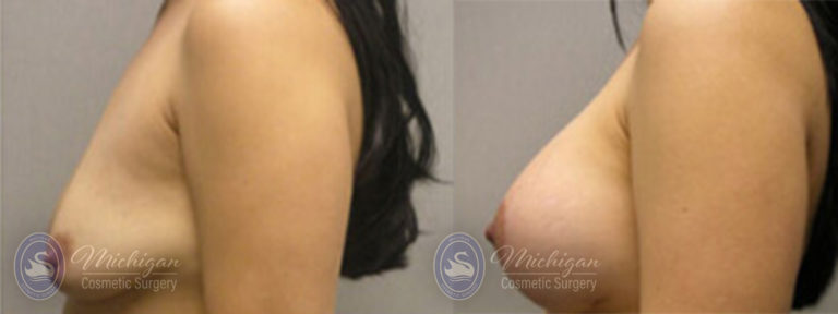 Breast Asymmetry Before and After Photo by Dr. Awada in Southfield Michigan
