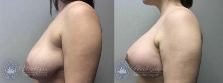 Breast Asymmetry Before and After Photo by Dr. Awada in Southfield Michigan