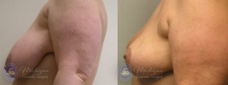 Breast Asymmetry Before and After Photo by Dr. Awada in Southfield Michigan