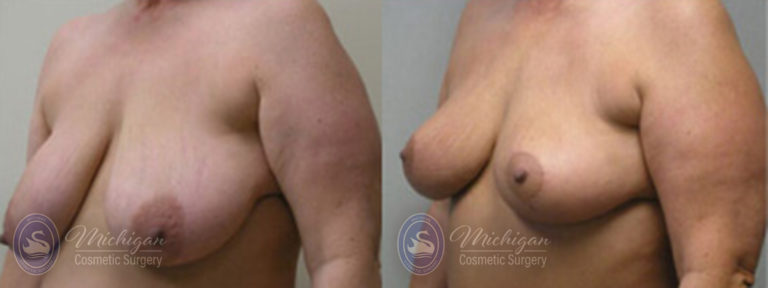 Breast Asymmetry Before and After Photo by Dr. Awada in Southfield Michigan