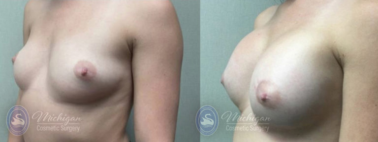 Breast Asymmetry Before and After Photo by Dr. Awada in Southfield Michigan