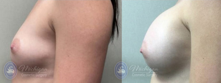 Breast Asymmetry Before and After Photo by Dr. Awada in Southfield Michigan