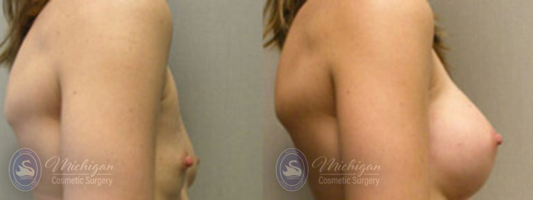 Breast Asymmetry Before and After Photo by Dr. Awada in Southfield Michigan