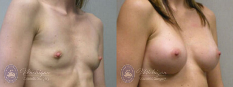 Breast Asymmetry Before and After Photo by Dr. Awada in Southfield Michigan