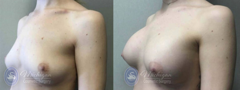 Breast Asymmetry Before and After Photo by Dr. Awada in Southfield Michigan