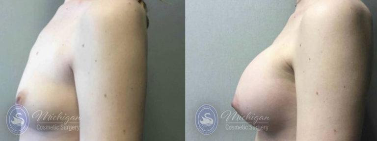 Breast Asymmetry Before and After Photo by Dr. Awada in Southfield Michigan