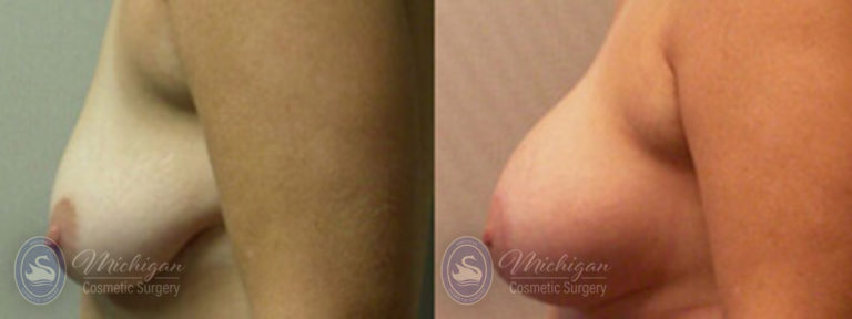 Breast Asymmetry Before and After Photo by Dr. Awada in Southfield Michigan