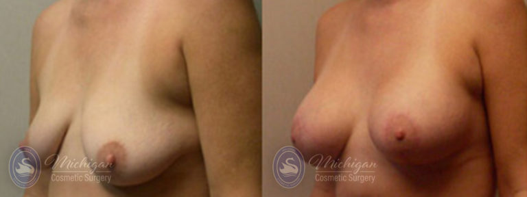 Breast Asymmetry Before and After Photo by Dr. Awada in Southfield Michigan