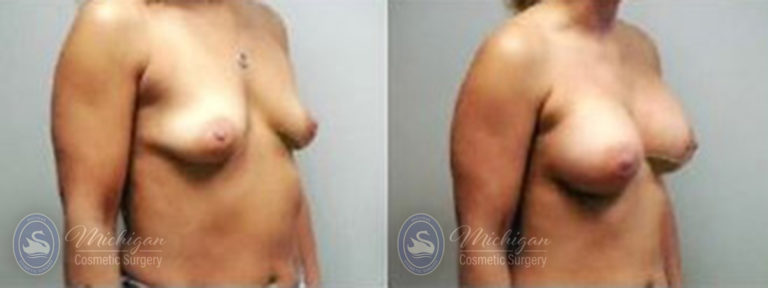 Breast Asymmetry Before and After Photo by Dr. Awada in Southfield Michigan