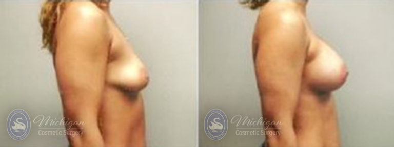 Breast Asymmetry Before and After Photo by Dr. Awada in Southfield Michigan