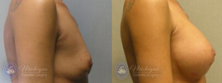 Breast Asymmetry Before and After Photo by Dr. Awada in Southfield Michigan