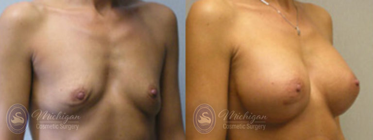 Breast Asymmetry Before and After Photo by Dr. Awada in Southfield Michigan