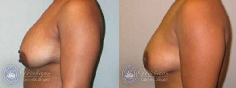 Breast Asymmetry Before and After Photo by Dr. Awada in Southfield Michigan