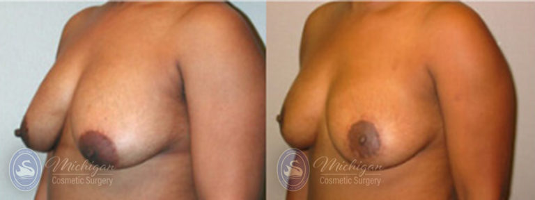 Breast Asymmetry Before and After Photo by Dr. Awada in Southfield Michigan