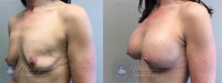Breast Asymmetry Before and After Photo by Dr. Awada in Southfield Michigan