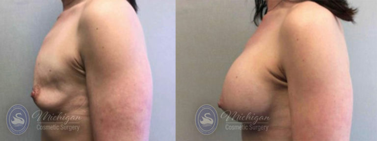 Breast Asymmetry Before and After Photo by Dr. Awada in Southfield Michigan