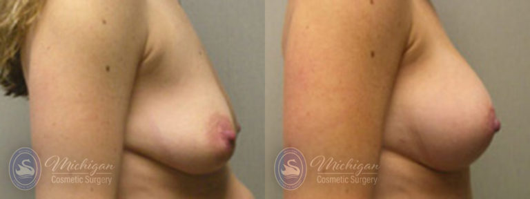Breast Augmentation with Medium Lift Before and After Photo by Dr. Awada in Southfield Michigan