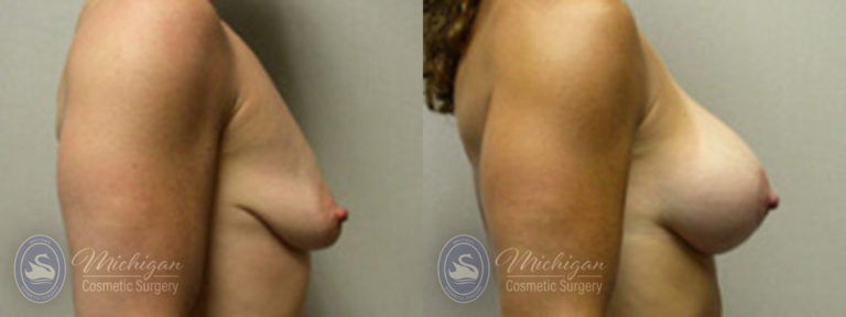 Breast Augmentation with Medium Lift Before and After Photo by Dr. Awada in Southfield Michigan