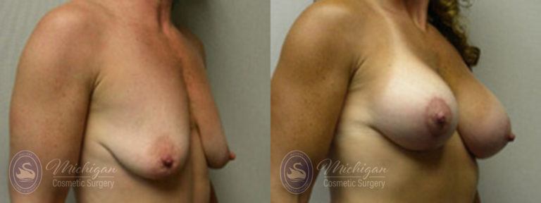Breast Augmentation with Medium Lift Before and After Photo by Dr. Awada in Southfield Michigan