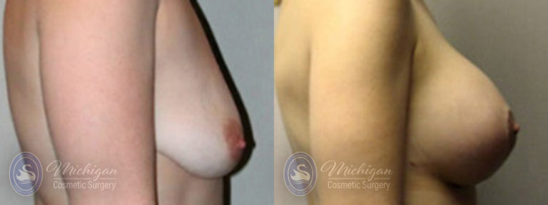 Breast Augmentation with Medium Lift Before and After Photo by Dr. Awada in Southfield Michigan
