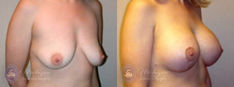 Breast Augmentation with Medium Lift Before and After Photo by Dr. Awada in Southfield Michigan