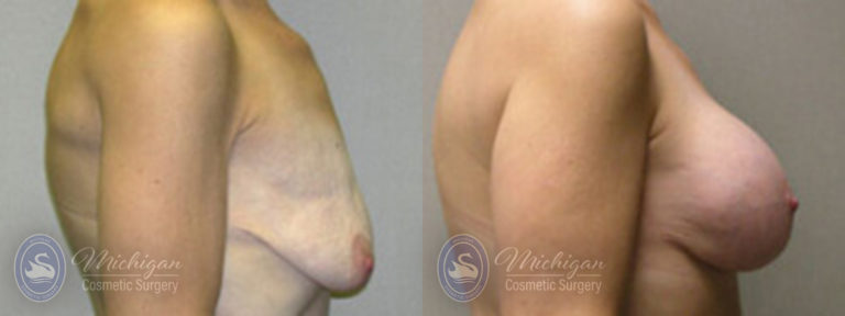 Breast Augmentation with Medium Lift Before and After Photo by Dr. Awada in Southfield Michigan