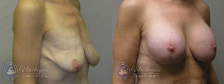 Breast Augmentation with Medium Lift Before and After Photo by Dr. Awada in Southfield Michigan