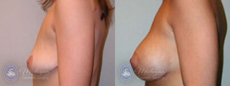Breast Augmentation with Medium Lift Before and After Photo by Dr. Awada in Southfield Michigan