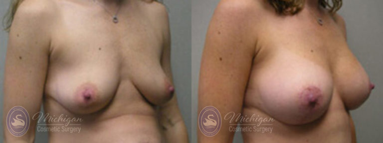 Breast Augmentation with Medium Lift Before and After Photo by Dr. Awada in Southfield Michigan