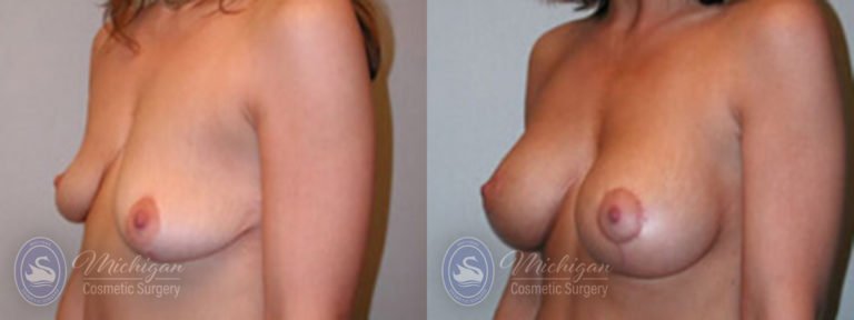 Breast Augmentation with Medium Lift Before and After Photo by Dr. Awada in Southfield Michigan