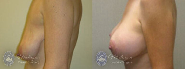 Breast Augmentation with Medium Lift Before and After Photo by Dr. Awada in Southfield Michigan