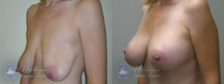 Breast Augmentation with Medium Lift Before and After Photo by Dr. Awada in Southfield Michigan