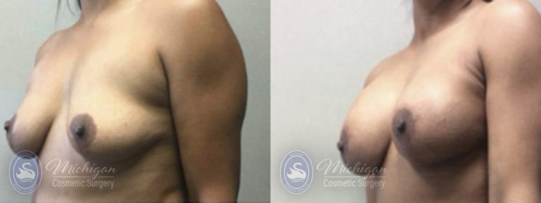 Breast Augmentation with Medium Lift Before and After Photo by Dr. Awada in Southfield Michigan