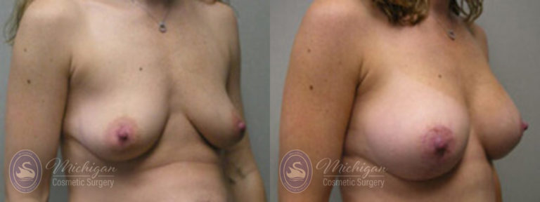 Breast Augmentation with Medium Lift Before and After Photo by Dr. Awada in Southfield Michigan