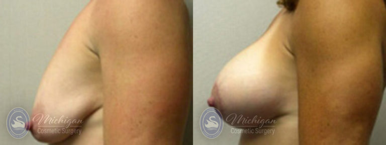 Breast Augmentation with Medium Lift Before and After Photo by Dr. Awada in Southfield Michigan